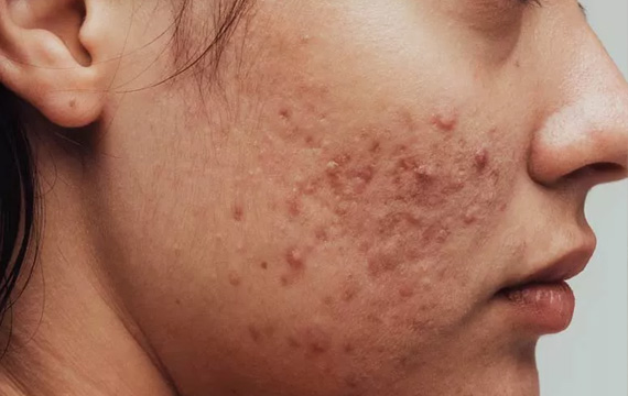 Acne - SVS MedAesthetics